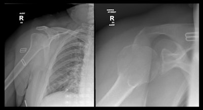 Greater tuberosity fracture overlooked on initial imaging.