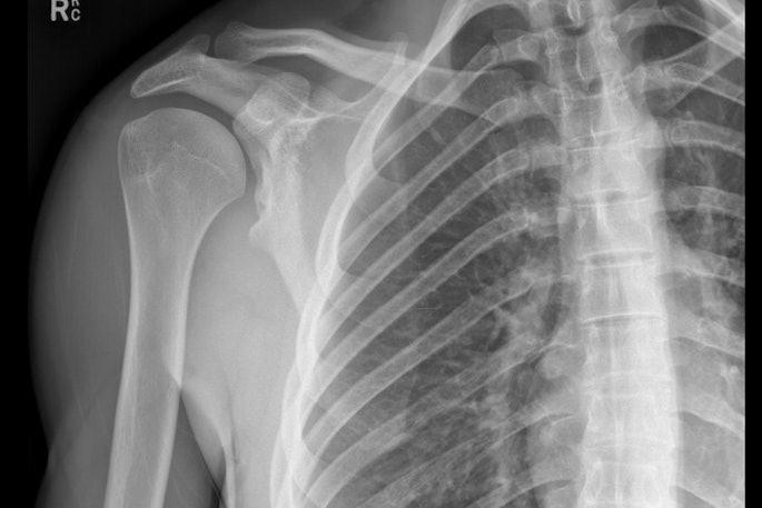 Dysplastic glenoid tubercle predisposing patient to recurrent dislocations.