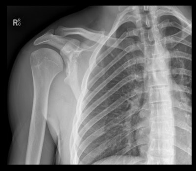 Dysplastic glenoid tubercle predisposing patient to recurrent dislocations.