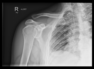 Acromioclavicular dislocation in suspected shoulder dislocation.
