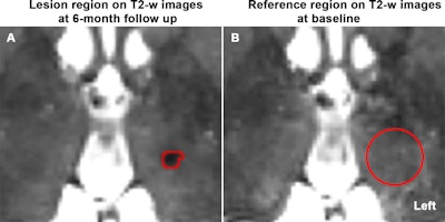 Definition of regions for lesion normalized contrast calculation on T2-weighted images. (A) Axial T2-weighted image at the 6-month follow-up shows the lesion (outlined in red) in a patient who underwent left-sided MRI-guided focused ultrasound thalamotomy. (B) The corresponding baseline T2-weighted image with a cylindrical reference region (red circle, 16-mm diameter, matching the lesion section number and centered at the lesion centroid) used to measure normal tissue intensity. The same regions were used for lesion normalized contrast calculation on T1/T2-weighted ratio images.