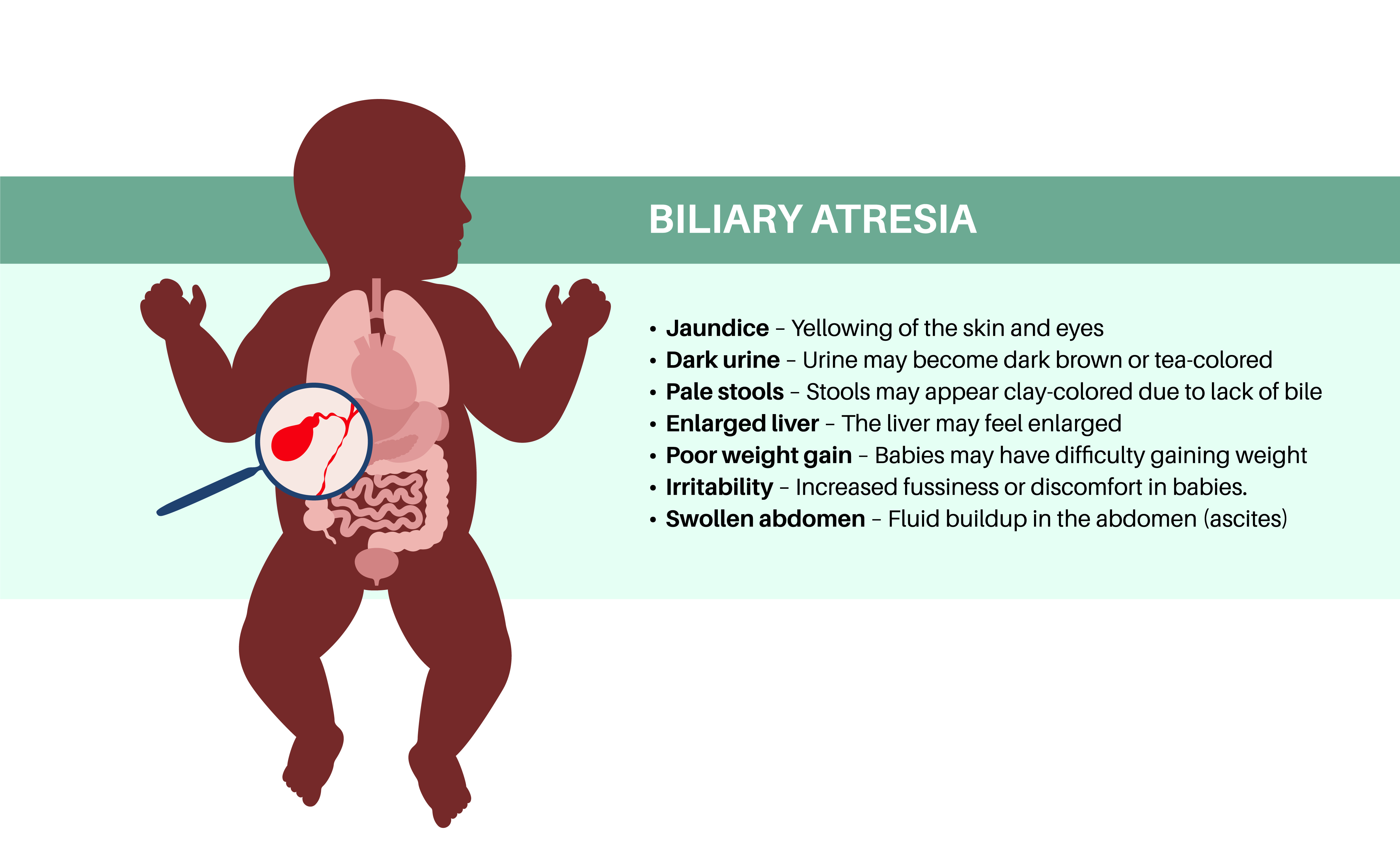 Biliary Atresia Disease Adobe Pikovit