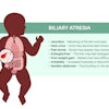 Biliary Atresia Disease Adobe Pikovit