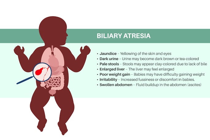 Biliary Atresia Disease Adobe Pikovit