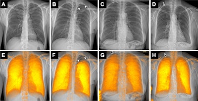 Examples of attenuation-based conventional radiographs (A-D) without and (E-H) with dark-field overlay in a (A, E) 49-year-old male participant without pneumothorax and (B-D, F-G) three participants with pneumothorax. The participants with pneumothorax included (B, F) a 32-year-old male participant with left-sided apical, pronounced pneumothorax (arrowheads), (C, G) a 72-year-old female participant with a small right-sided apical pneumothorax (arrowheads) in whom thoracic drainage has already been inserted on the right side, and (D, H) a 75-year-old female participant with a small right-sided apical pneumothorax (arrow), in whom the pneumothorax is even more obvious on the radiograph with dark-field overlay (arrowheads). (C, G) In the 72-year-old female participant, the pneumothorax line is hard to recognize on the conventional radiograph without overlay (due to overlay of ribs); it appears to be easier to recognize on the image with the dark-field overlay due to the signal loss in that area. (D, H) In the 75-year-old participant, the small pneumothorax is difficult to recognize on both the image without overlay (D) due to ribs in that area, and the image with dark-field overlay (H) due to an ill-defined margin of the dark-field signal combined with residual beam-hardening-induced dark-field signal from the ribs. In G, the dark-field signal in the lower left corner is due to an attached band-aid.