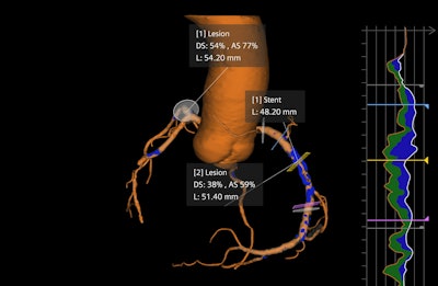 Syngo.CT Coronary Cockpit provides AI-powered cardiac plaque analysis.