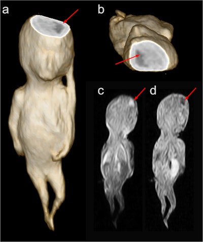 Volume rendering of Fetus 1 with a virtual cut through the brain illustrates a cerebral finding in the left parietal brain (a and b). The cerebral finding is hyperintense (bright) on T2-weighted MRI (c) and a hypointense (dark) on T1-weighted MRI (d).