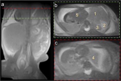 Fetus 2, with a left-sided diaphragmatic hernia (a) characterized by displacement of the liver (1), spleen (2), and intestinal loops (3) into the left hemithorax, along with left lung hypoplasia (4) and a rightward shift of the heart (5).