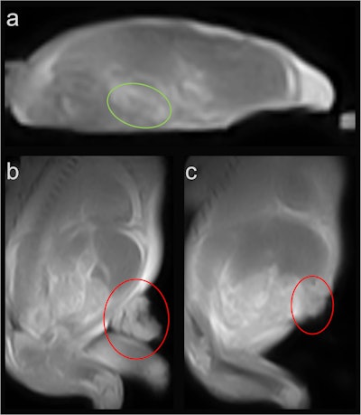 Fetus 3, showing a suspected oligocystic kidney (a, green circle), as well as a defect due to gastroschisis with herniated bowel (b and c, red circle).