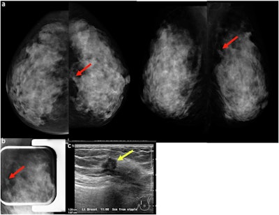 (a) A 45-year-old woman underwent a baseline screening mammogram, which was interpreted as normal by one reader. A second reader identified a possible isodense mass in the upper inner quadrant of the left breast, projected over the retromammary fat (red arrows, left craniocaudal and mediolateral oblique mammograms). (b) Spot compression left lateral-medial mammogram demonstrated an irregular mass with spiculated margins (red arrow) in the area of concern. (c) Targeted ultrasound demonstrated a correlating irregular hypoechoic mass with indistinct margins (yellow arrow). Ultrasound-guided core biopsy revealed invasive ductal carcinoma.