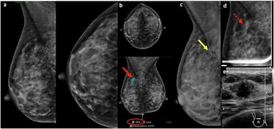 (a) Screening mammogram in a 44-year-old woman initially interpreted as normal by the radiologist on a particularly busy day. (b) Subsequent computer-aided diagnosis (CAD) analysis using Lunit INSIGHT MMG v1.1.7.1 annotated an isodense asymmetry with associated microcalcifications (red arrow) in the upper posterior right breast, seen on mediolateral oblique projection only. CAD flagged this area (red arrow) with a 38% likelihood of malignancy (red circle). (c) Retrospective review of a prior mammogram from a year ago revealed a small group of round microcalcifications in linear distribution (yellow arrow) in the area of CAD interest, not previously described. (d) Magnification imaging showed persistent asymmetry (dotted red arrow) with subtle architectural distortion and microcalcifications in the area of concern. (e) Ultrasound shows a corresponding irregular, nonparallel, hypoechoic mass with indistinct margins. Ultrasound-guided biopsy revealed grade 3 invasive ductal carcinoma.