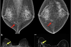 (a) Mediolateral oblique and craniocaudal screening mammograms in a 52-year-old woman demonstrated an isodense focal asymmetry in the lower inner right breast, projected over the retromammary fat (red arrows). This finding was not reported by the first reader, likely due to its location at the periphery of the image, and was reported by the second reader. Assessment with ultrasound (not shown) was unremarkable. (b) Breast MRI was subsequently performed, and the axial maximum intensity projection image revealed an irregular enhancing mass in the lower right breast, corresponding to the mammographic asymmetry (yellow arrows). Axial image obtained during MRI-guided biopsy, which revealed histopathology of grade 2 invasive lobular carcinoma.