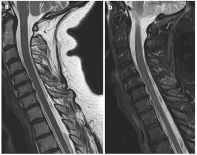 Sagittal T1-weighted (A) and STIR (B) MR images show small disc bulges and disc dehydration at multiple levels in keeping with degenerative change. All images courtesy of Prof. Rajesh Botchu.