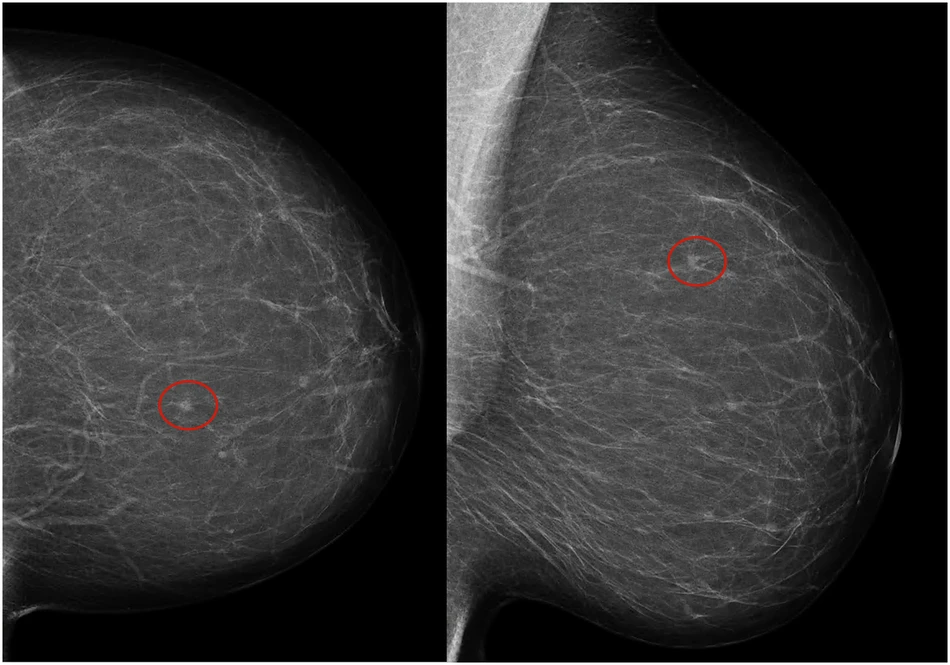 Left craniocaudal and mediolateral oblique mammograms in a 53-year-old woman with an invasive 4-mm histologic grade 1 screen-detected cancer. The exam-level AI score for v1.7 was 5 and 10 for v2.1 (increased AI score). The red circles mark the location of the tumor.