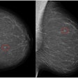Left craniocaudal and mediolateral oblique mammograms in a 53-year-old woman with an invasive 4-mm histologic grade 1 screen-detected cancer. The exam-level AI score for v1.7 was 5 and 10 for v2.1 (increased AI score). The red circles mark the location of the tumor.