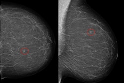 Left craniocaudal and mediolateral oblique mammograms in a 53-year-old woman with an invasive 4-mm histologic grade 1 screen-detected cancer. The exam-level AI score for v1.7 was 5 and 10 for v2.1 (increased AI score). The red circles mark the location of the tumor.