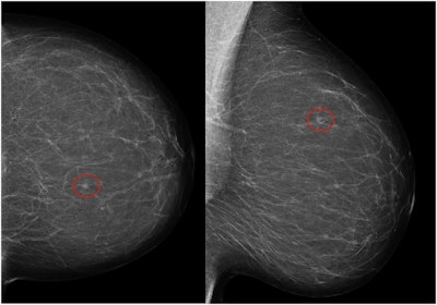 Left craniocaudal and mediolateral oblique mammograms in a 53-year-old woman with an invasive 4-mm histologic grade 1 screen-detected cancer. The exam-level AI score for v1.7 was 5 and 10 for v2.1 (increased AI score). The red circles mark the location of the tumor.