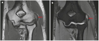 Coronal proton density (A) and proton density fat-suppressed (B) show edema and thickening of common extensor origin in keeping with lateral epicondylitis (arrow).