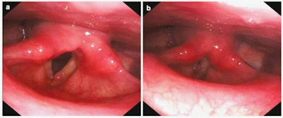 Video-laryngoscopic images show bilateral vocal cord polyp in abduction (A) and in adduction (B).