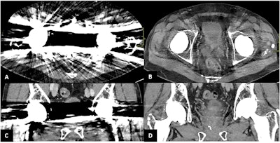 Patient with bilateral hip prosthesis undergoing PCCT scan. Axial and coronal views (A, C) show severe metal artifacts. Axial and coronal reconstructions after energy filtering (B, D) demonstrate a significant reduction in metal artifacts.