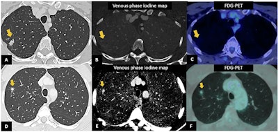 PCCT in the assessment of lung nodules. In a 62-year-old woman, chest PCCT (A) shows a lung parenchymal irregular nodule connected to the parietal pleura of the upper right lobe, without contrast uptake on the iodine map (B), resulting suggestive of a benign nodule. FDG-PET exam confirmed the benign nature for absent FDG uptake (C). In a 62-year-old man, PCCT shows the presence of an area of structural alteration of the lung parenchyma in the context of the right upper lung lobe, in the subpleural location, characterized by ground-glass pattern with overall size of 21 × 10 mm (D), containing a completely solid nodular component approximately of 1 cm in diameter, with contrast uptake on the venous iodine map, suggestive for cancer (E). FDG-PET confirmed the presence of an FDG avid nodule (F). At histological examination, it was diagnosed as lung lepidic adenocarcinoma (pT1a pN0)
