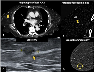 PCCT in breast cancer. Chest PCCT of a 55-year-old woman suffering from dyspnea: A angiographic chest examination showing an incidental finding of a mammary nodule in the lower inner quadrant of the right breast, with a diameter of 8 mm, with rim enhancement at arterial-phase iodine map (B). For the suspicious enhancement pattern, breast ultrasound and mammography were suggested. On the same side, breast mammography shows a small speculated margin opacity containing rare microcalcifications (D), and ultrasound (C) found a solid, hypoechoic nodule with ill-defined margins, suspected for neoplasia. Ultrasound-guided core needle biopsy was performed. At histological examination, it resulted in an invasive breast carcinoma of no special type.