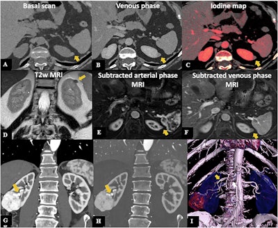 PCCT in renal cancer. A 57-year-old woman undergoing PCCT. Axial pre-contrast (A) and venous phase (B) scans show a small exophytic nodule of the superior pole of the left kidney (11 mm), slightly hyperdense in both phases, with mild iodine uptake at the iodine map (C), suggestive of a small papillary neoplasia rather than a hemorrhagic cyst. MRI confirmed the presence of a small left kidney nodule, hypointense in the T2w image (D), characterized by mild enhancement in the arterial phase (E), with minimal washout in the venous phase (F), thus confirming PCCT suspicion. PCCT in kidney tumor surgery planning: coronal angiographic CT scan showing an exophytic heterogeneous lesion in the mid-lower right kidney (G), 5 cm in diameter, with a well-defined hypertrophic vascular pole, further highlighted on the iodine map (H). 3D reconstruction shows a double right renal artery; the lesion is supplied by the more caudal branch (white arrow in I).