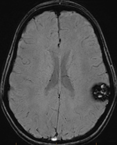 MRI brain axial SWI shows a well-defined lesion in the left posterior frontal/anterior parietal lobe. Prominent susceptibility artefact on SWI due to paramagnetic effect from hemosiderin deposits. The lesion had a lobulated appearance on T1 and T2 with no surrounding edema and was confirmed as a cerebral cavernous malformation.