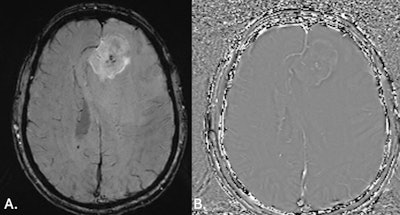 (A) MRI brain SWI axial scan shows left frontal lobe lesion with mass effect and blooming artefact representing microhemorrhages within the lesion (note that contrast was given to the patient prior to acquisition of SWI images). (B) MRI brain SWI phase images axial: haemorrhagic lesion shows a bright/positive shift on the phase image due to paramagnetic susceptibility effect. All figures courtesy of Dr. India Plath and Prof. Alan Coulthard, Department of Medical Imaging, Royal Brisbane and Women’s Hospital.