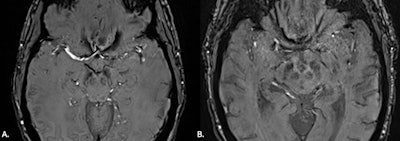 (A) MRI brain SWI axial scan shows normal appearance of nigrosome-1, high signal in a linear shape within the substantia nigra. Also known as swallow tail sign. (B) MRI brain SWI axial: substantia nigra signal intensity reduced bilaterally, with loss of the hyperintense signal in nigrosome-1 in keeping with loss of swallow tail sign, which may reflect Parkinson’s disease.