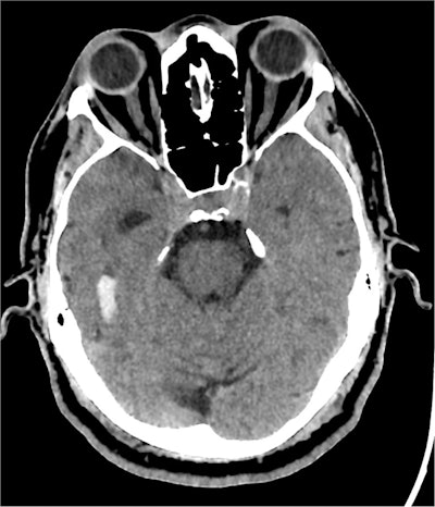 CT image of the head with a right temporal parenchymal hemorrhage, from the previous analysis using GPT-4V. GPT-4V correctly identified the image modality, anatomical region, and pathology of “intracranial hemorrhage”.