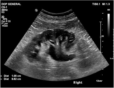 Ultrasound image of the right kidney demonstrating hydronephrosis from the previous analysis. GPT-4V identified the modality but misidentified the anatomical region as “pelvis” and the pathology as “cholelithiasis”.