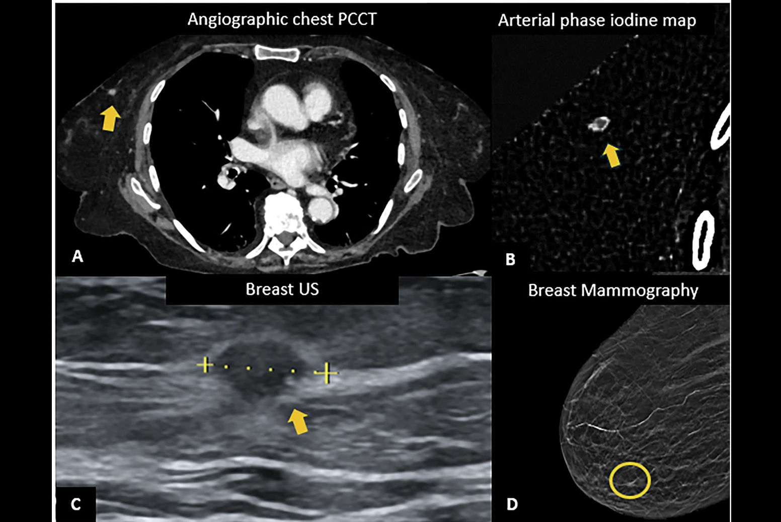 2026 01 26 Pcct Breast Cancer Thumbnail