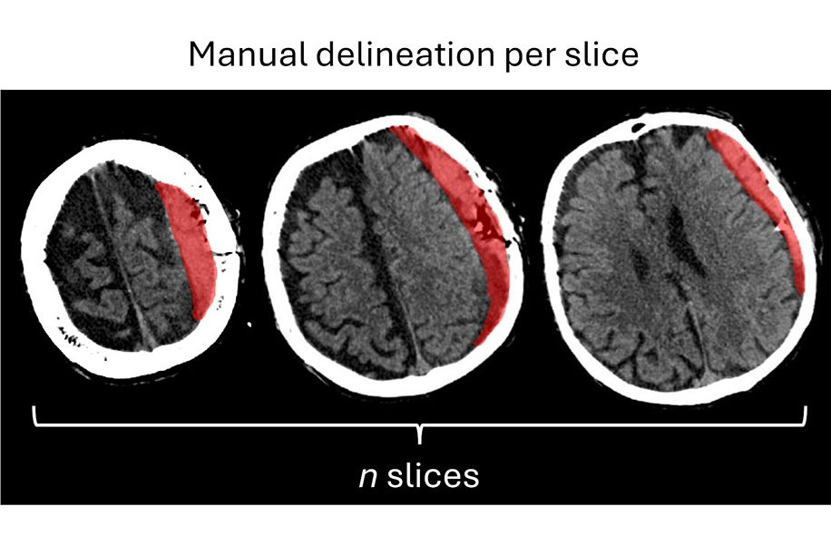 2026 01 27 Hematoma Volume Thumbnail