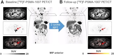 Representative case example of patient responding to Ac-225 PSMA RPT. (A) Baseline F-18 PSMA-1007 PET/CT with maximum-intensity projection (MIP), CT (top), PET (center), and fused PET/CT (bottom). This patient demonstrated high PSMA expression on pretherapeutic PET as can be seen in representative metastasis in second thoracic vertebral body (indicated by arrows) with averaged mean standardized uptake value (SUVmean) of 8.44 (median of all patients, 6.8). In line with high SUVmean and only moderate tumor burden, PSMA-TLQ was low (38.9 mL; median of all patients, 150.4 mL). After two cycles of Ac-225 PSMA RPT, PSA declined from 20.5 to 9.0 μg/L (−56.1%). (B) Follow-up F-18 PSMA-1007 PET/CT with MIP, CT (top), PET (center), and fused PET/CT (bottom). In line with biochemical response, there was partial response with decline of PSMA-TV from 328.42 to 150.34 mL (−54.2%). This patient achieved PFS of 167 days (median of all patients, 107 days) and overall survival of 592 days (median of all patients, 275 days), which was in line with high SUVmean and low PSMA-TLQ on baseline PET.