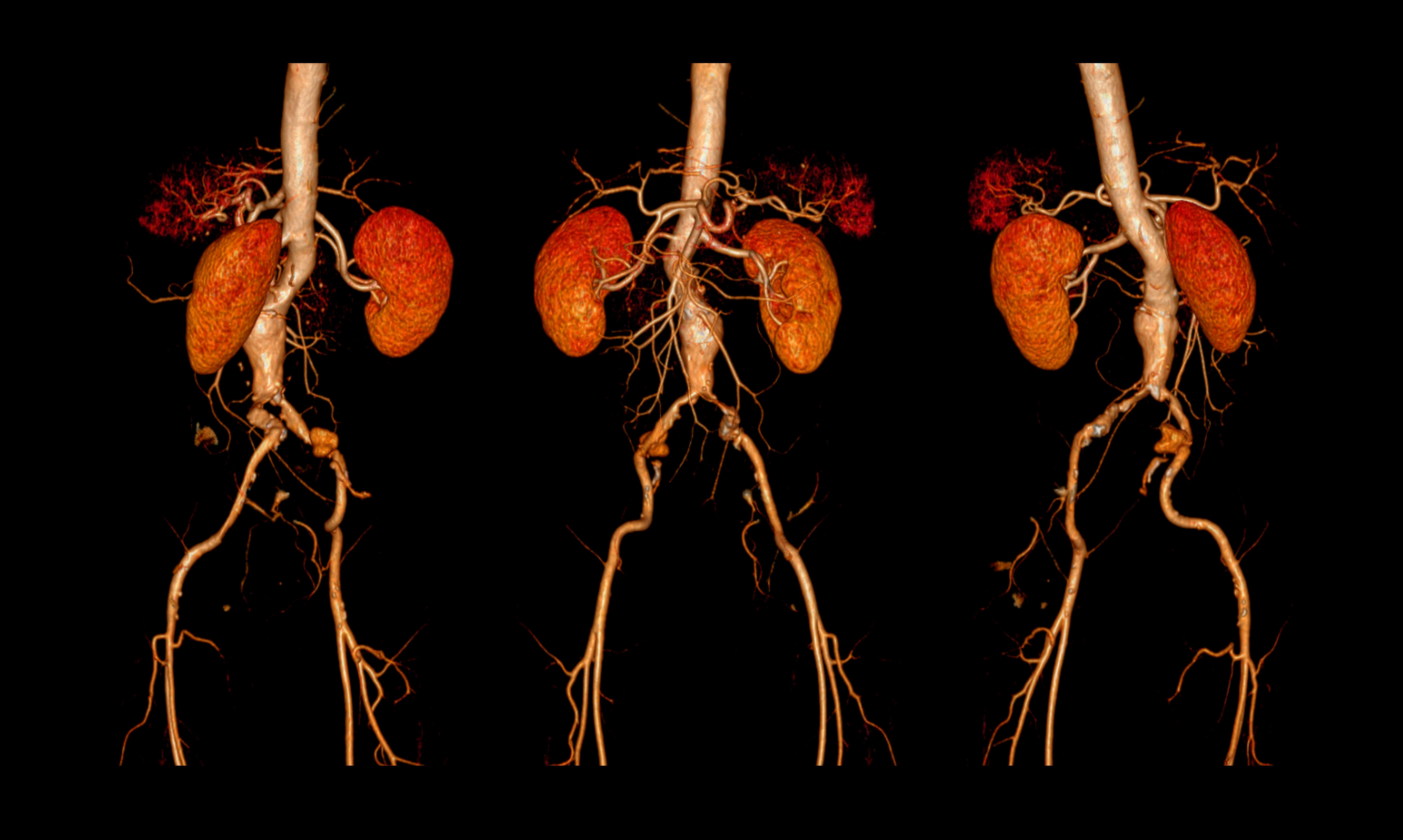 Cta Abdominal Aorta Femoral Run Off Findings Adobe Samunella