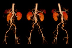 Cta Abdominal Aorta Femoral Run Off Findings Adobe Samunella