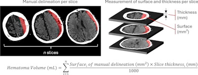 An image demonstrating manual subdural hematoma segmentation and volume calculation.
