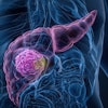 Pancreas Cancerous Area 3 D Rendering Adobe Anton