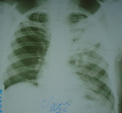 A sample input analyzed by the AI model. The film chest x-ray was photographed with a Sony Cyber-shot 20.1 MP digital camera.