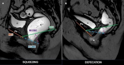 Anterior rectocele with pelvic floor descent during defecation phase, consistent with pelvic floor dyssynergia and structural pelvic organ prolapse. Midsagittal fast field echo (BFFE) images during the squeezing phase (left) and defecation phase (right) demonstrate anorectal angle dynamics. During defecation, note the presence of an anterior rectocele (*), protruding beyond the H-line, indicating pelvic floor dysfunction. Pubic symphysis (Ps), rectum (R), bladder (B).