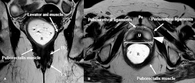 Normal female pelvic floor anatomy. (A): Coronal T2-weighted MR defecography highlighting the levator ani complex and both internal and external anal sphincters. (B) Axial T2-weighted image depicts the urethral support structures: periurethral ligaments from the puborectalis, paraurethral ligaments (arrowheads) from the urethral wall, and pubourethral ligaments from the pubic bone to the urethra. The vagina (V) shows a typical H-shaped configuration. Ps = pubic symphysis, R = rectum, U = urethra, IS: internal anal sphincter, ES: external anal sphincter.