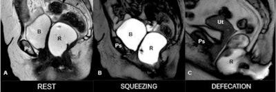 Real-time evaluation of PFD Using T2-weighted interactive single shot sequence (SSFSE) in dynamic MR defecography. Dynamic MR defecography using T2-weighted SSFSE sequence shows pelvic floor anatomy at rest (A), during squeezing (B), and defecation (C). Progressive descent of pelvic organs suggests pelvic floor dysfunction. B: bladder, Ps = pubic symphysis, R: rectum, Ut: Uterus.