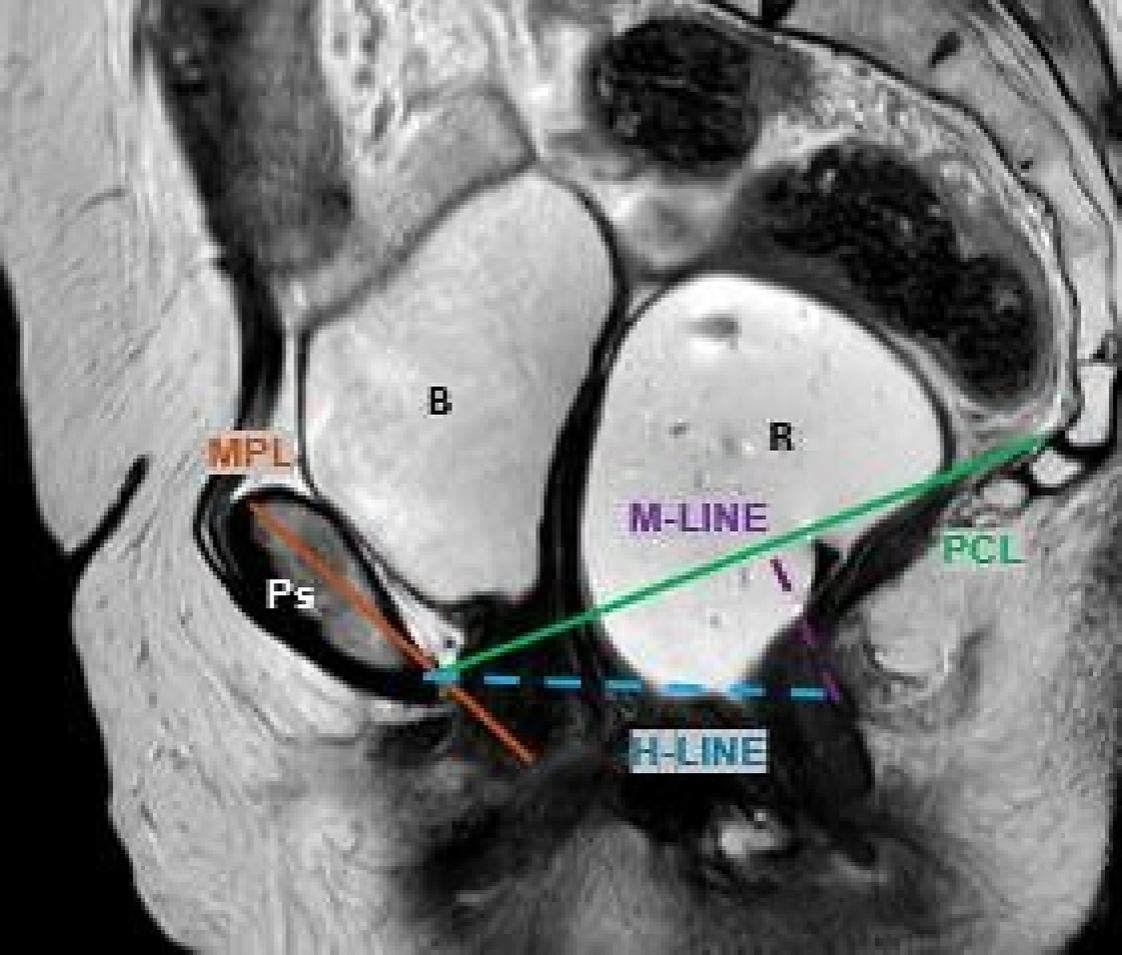 Sagittal T2-weighted MRD image at maximal pelvic floor contraction (squeeze). The pubococcygeal line (PCL) serves as a reference line extending from the inferior border of the pubic symphysis to the last coccygeal joint. The H line represents the anteroposterior dimension of the levator hiatus, while the M line measures the perpendicular descent of the levator plate relative to the PCL. The midpubic line (MPL) provides an additional reference for anterior-posterior alignment. Identifiable pelvic structures include the pubic symphysis (Ps), rectum (R), and bladder (B).