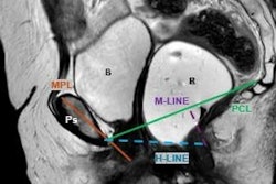 Sagittal T2-weighted MRD image at maximal pelvic floor contraction (squeeze). The pubococcygeal line (PCL) serves as a reference line extending from the inferior border of the pubic symphysis to the last coccygeal joint. The H line represents the anteroposterior dimension of the levator hiatus, while the M line measures the perpendicular descent of the levator plate relative to the PCL. The midpubic line (MPL) provides an additional reference for anterior-posterior alignment. Identifiable pelvic structures include the pubic symphysis (Ps), rectum (R), and bladder (B).