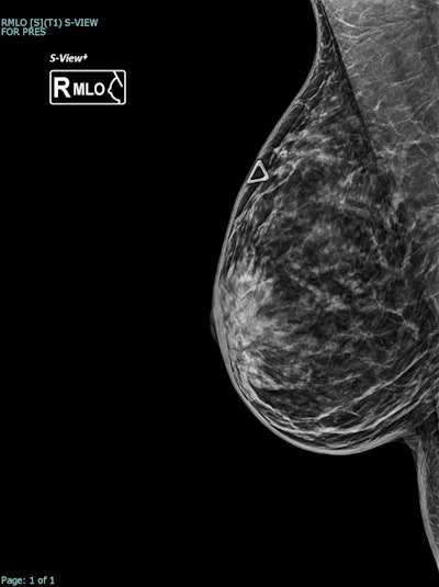 Correlative mammographic, sonographic, and histopathological findings in a 44-year-old woman with a palpable right breast lump. Synthesised 2D mammogram, right breast, mediolateral oblique (MLO) projection: No discrete abnormality is visualised. Interpretation is limited by heterogeneously dense parenchyma (density grade C). All figures courtesy of Dr. Ben Trinh, Dr. Vanessa Atienza-Hipolito, Women’s & Breast Imaging, presented at RANZCR 2025.