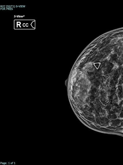 Synthesized 2D mammogram, right breast, craniocaudal (CC) projection of the same patient. No mammographic abnormality is identified. Dense fibroglandular tissue (density grade C) reduces sensitivity.