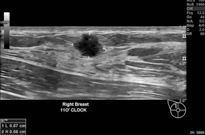 Right breast, 11 o’clock position, same patient. An 11 mm irregular hypoechoic solid lesion with microlobulated margins, ductal extension, adjacent fat plane distortion, and internal vascularity on Doppler. This corresponds to the palpable abnormality. Biopsy confirmed invasive ductal carcinoma, Grade 2, ER positive, PR positive, HER2 positive, concordant with imaging findings.