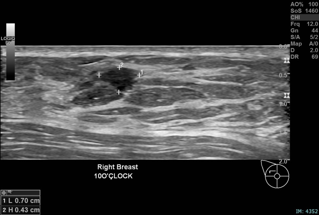Right breast, 10 o&rsquo;clock position, same patient: A 15 mm irregular hypoechoic solid lesion with suspicious morphology, situated approximately 6 mm from the index lesion. Biopsy confirmed invasive ductal carcinoma, Grade 2, ER positive, PR positive, HER2 positive, concordant with ultrasound features. Findings are in keeping with multifocal invasive ductal carcinoma in a heterogeneously dense breast. The patient was referred for surgical management.