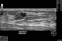 Right breast, 10 o’clock position, same patient: A 15 mm irregular hypoechoic solid lesion with suspicious morphology, situated approximately 6 mm from the index lesion. Biopsy confirmed invasive ductal carcinoma, Grade 2, ER positive, PR positive, HER2 positive, concordant with ultrasound features. Findings are in keeping with multifocal invasive ductal carcinoma in a heterogeneously dense breast. The patient was referred for surgical management.